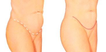 abdominoplastia antes y despues