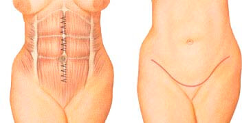 abdominoplastia antes y despues