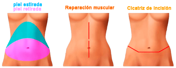 Abdominoplastia convencional