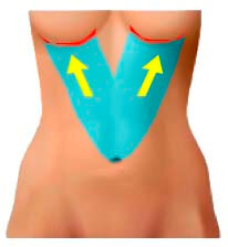 Abdominoplastia invertida