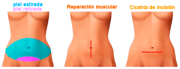 Abdominoplastia parcial