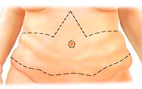 Abdominoplastia postbariatrica