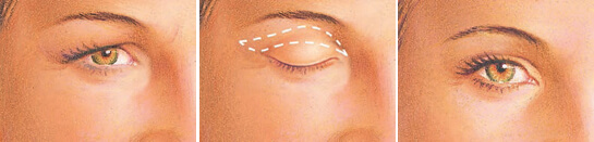 blefaroplastia incision parpado