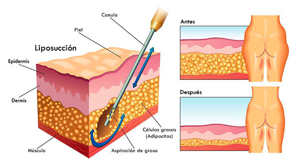 Efecto de la liposucción en la piel