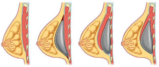 Planos de posición de implantes mamarios