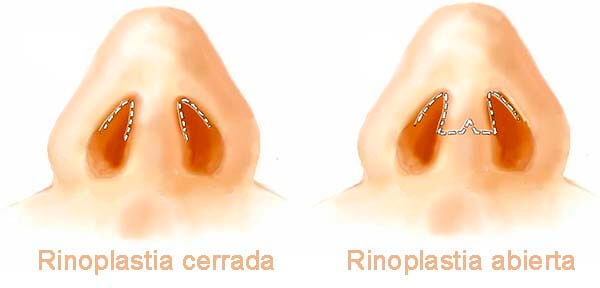 rinoplastia incisiones abierta cerrada